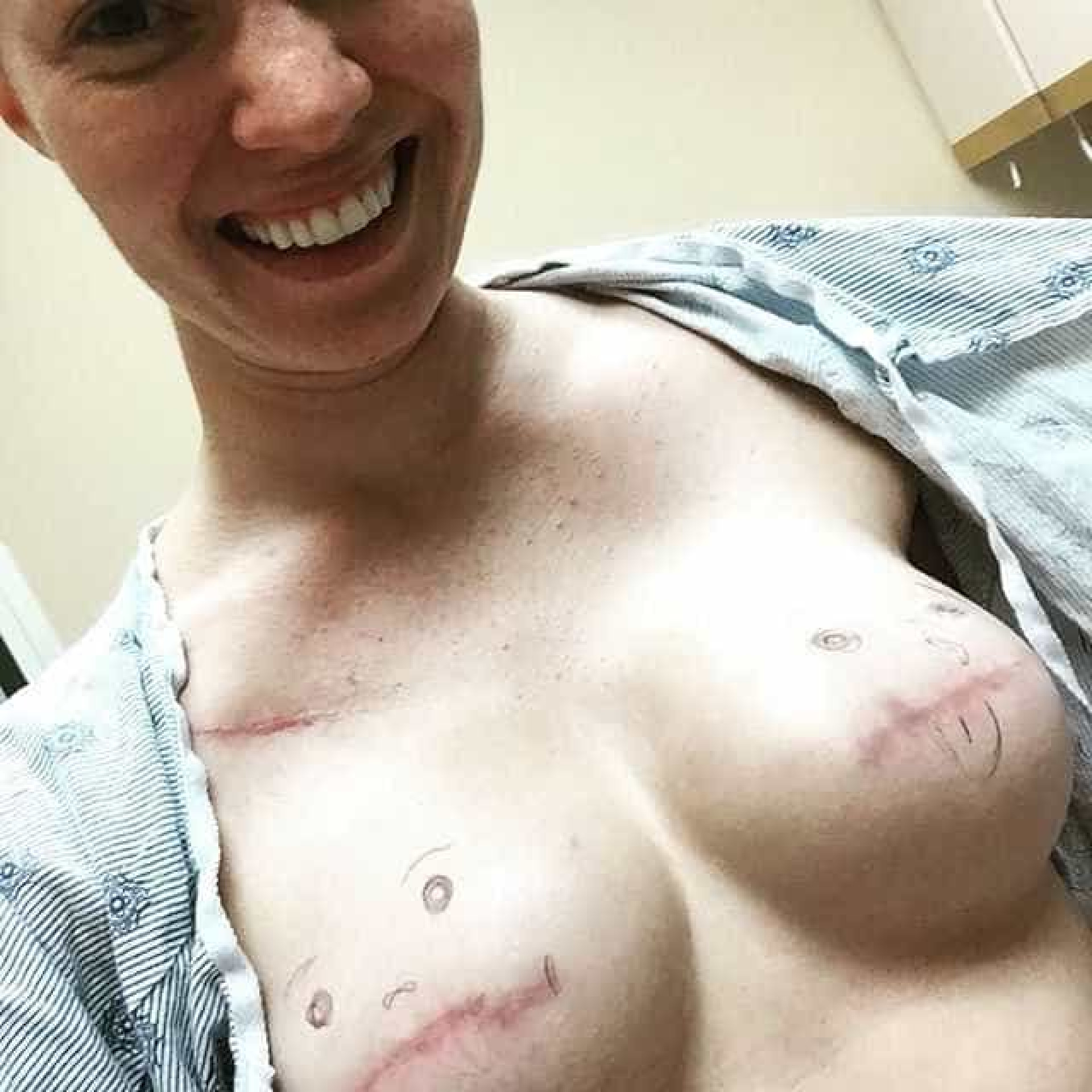 женщины с ампутированными грудями фото фото 99